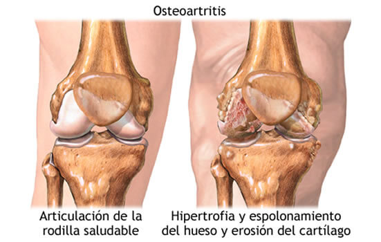 Comparación anatómica entre articulación de rodilla saludable y osteoartritis avanzada — ArtiZynt reconstruye el cartílago dañado