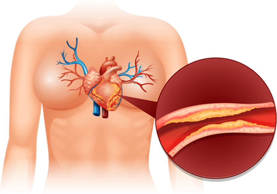 Corazón humano con arteria obstruida y colesterol acumulado — Hypertonica baja presión arterial y colesterol LDL